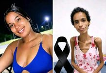 Cancer-Stricken Emily’s Painful Account: The Underestimated Peril of Smoking
