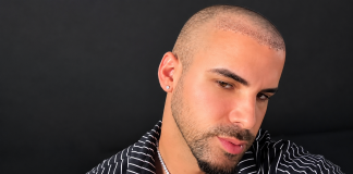 Alex Bebert Shares Day 5 Hair Transplant Update