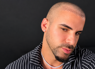 Alex Bebert Shares Day 5 Hair Transplant Update