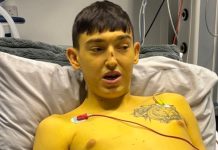 Cheshire Man’s Skin Turns Yellow Before Life-Saving Liver Transplant