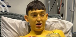 Cheshire Man’s Skin Turns Yellow Before Life-Saving Liver Transplant