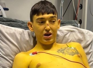 Cheshire Man’s Skin Turns Yellow Before Life-Saving Liver Transplant