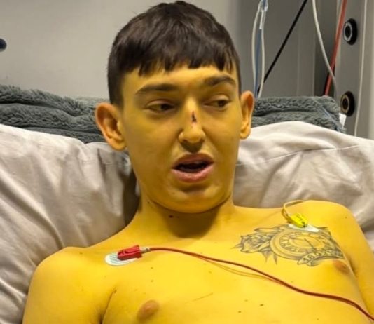 Cheshire Man’s Skin Turns Yellow Before Life-Saving Liver Transplant